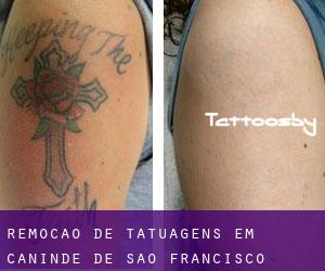 Remoção de tatuagens em Canindé de São Francisco