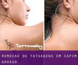 Remoção de tatuagens em Capim Grosso