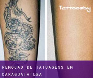 Remoção de tatuagens em Caraguatatuba