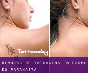 Remoção de tatuagens em Carmo do Paranaíba