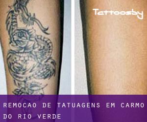Remoção de tatuagens em Carmo do Rio Verde