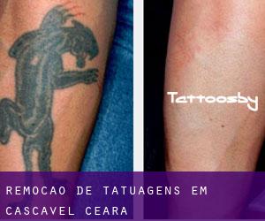 Remoção de tatuagens em Cascavel (Ceará)