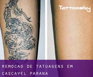 Remoção de tatuagens em Cascavel (Paraná)