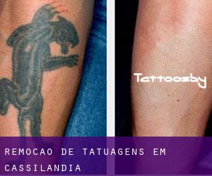 Remoção de tatuagens em Cassilândia