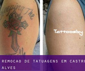 Remoção de tatuagens em Castro Alves
