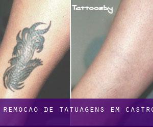 Remoção de tatuagens em Castro