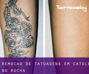 Remoção de tatuagens em Catolé do Rocha