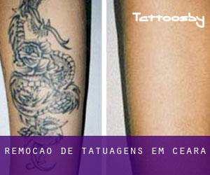 Remoção de tatuagens em Ceará