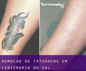 Remoção de tatuagens em Centenário do Sul