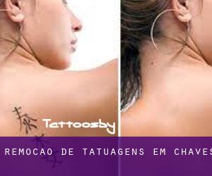 Remoção de tatuagens em Chaves