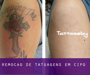Remoção de tatuagens em Cipó