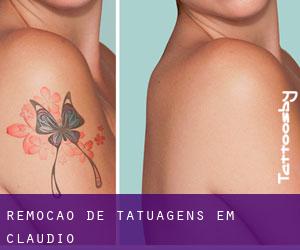 Remoção de tatuagens em Cláudio