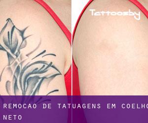 Remoção de tatuagens em Coelho Neto