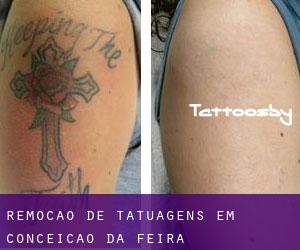 Remoção de tatuagens em Conceição da Feira