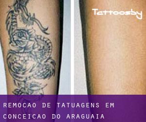 Remoção de tatuagens em Conceição do Araguaia