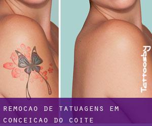 Remoção de tatuagens em Conceição do Coité