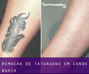 Remoção de tatuagens em Conde (Bahia)