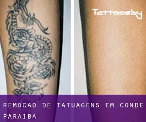 Remoção de tatuagens em Conde (Paraíba)