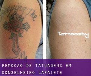 Remoção de tatuagens em Conselheiro Lafaiete