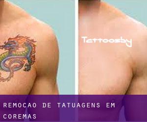 Remoção de tatuagens em Coremas