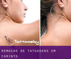 Remoção de tatuagens em Corinto