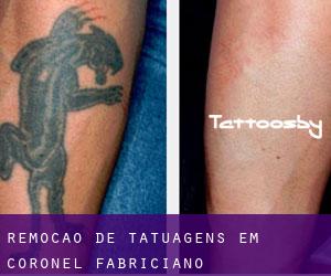 Remoção de tatuagens em Coronel Fabriciano