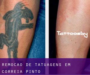 Remoção de tatuagens em Correia Pinto