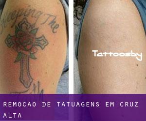 Remoção de tatuagens em Cruz Alta
