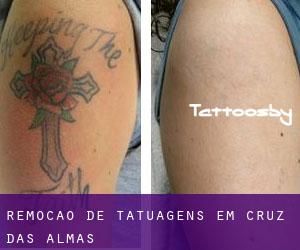 Remoção de tatuagens em Cruz das Almas