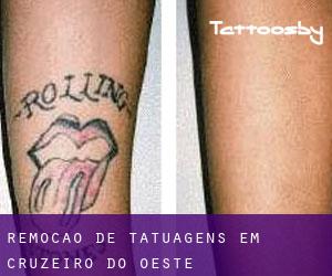 Remoção de tatuagens em Cruzeiro do Oeste