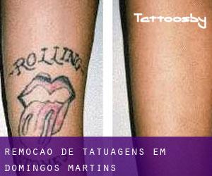 Remoção de tatuagens em Domingos Martins
