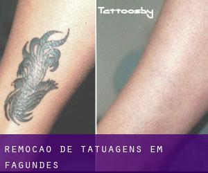 Remoção de tatuagens em Fagundes