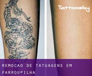 Remoção de tatuagens em Farroupilha