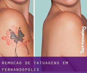 Remoção de tatuagens em Fernandópolis
