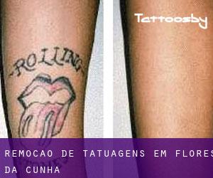 Remoção de tatuagens em Flores da Cunha