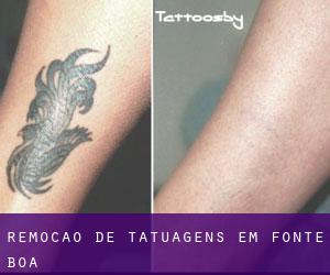 Remoção de tatuagens em Fonte Boa