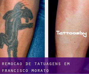 Remoção de tatuagens em Francisco Morato