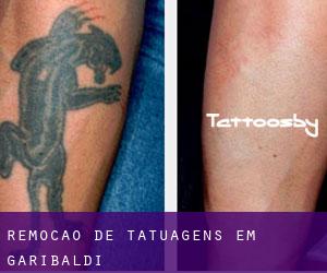Remoção de tatuagens em Garibaldi