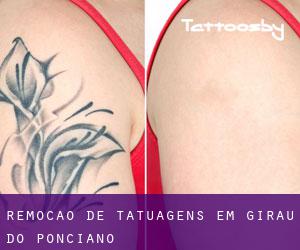 Remoção de tatuagens em Girau do Ponciano