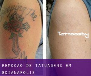 Remoção de tatuagens em Goianápolis
