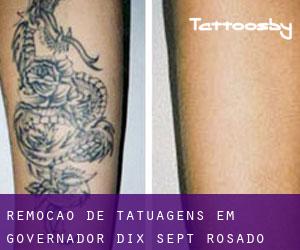 Remoção de tatuagens em Governador Dix-Sept Rosado