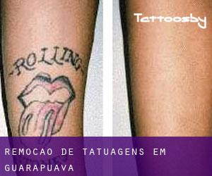 Remoção de tatuagens em Guarapuava