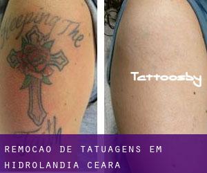 Remoção de tatuagens em Hidrolândia (Ceará)