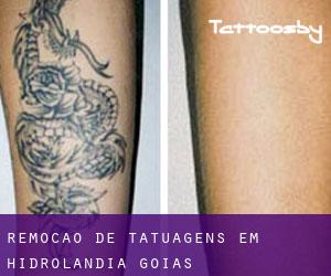 Remoção de tatuagens em Hidrolândia (Goiás)