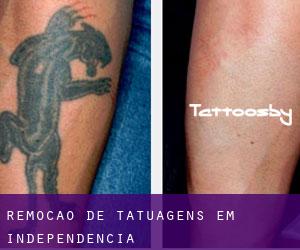 Remoção de tatuagens em Independência