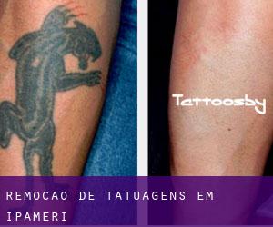 Remoção de tatuagens em Ipameri