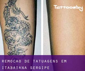 Remoção de tatuagens em Itabaiana (Sergipe)