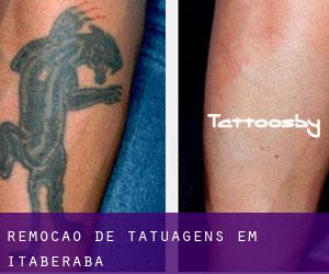 Remoção de tatuagens em Itaberaba