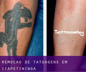 Remoção de tatuagens em Itapetininga