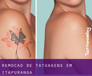 Remoção de tatuagens em Itapuranga